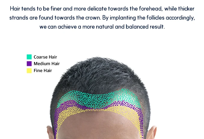 Hair transplant follicle mapping by hair zone – Men's hair care in Busan, Korea